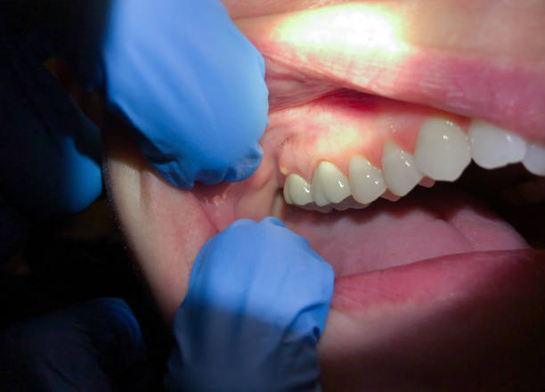 Best Tooth Infection Emergency Dentist  in Mountain View Acres, CA